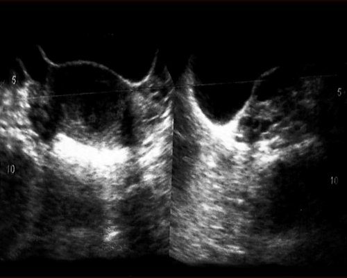 Эхограмма - порок развития половой системы (неполное удвоение матки, рудиментарный замкнутый рог матки справа, гематометра справа, множественные гидатиды маточных труб, кольпит)