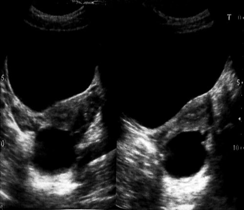 Эхограмма - параоварильная киста слева, гидатиды маточных труб