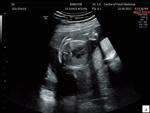 Эхограмма - 4-камерный срез сердца плода (сканирование в общем акушерском режиме)