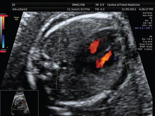 Эхограмма - 4-камерный срез сердца плода (режим ЦДК), значения скоростной шкалы установлены на 38 см/с, что позволяет получить изображение ламинарного тока крови в желудочках