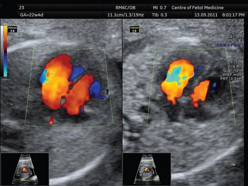 Эхограмма - 4-камерный срез сердца плода (режим ЦДК), в левой части экрана представлено изображение с высоким усилением цветового сигнала, справа - сбалансированное по силе цветового сигнала изображение