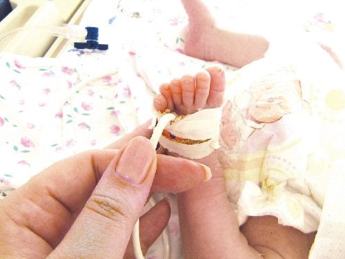 Фото - полидактилия стопы новорожденного