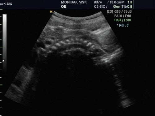 Эхограмма - гиперразгибание шейного отдела позвоночника плода