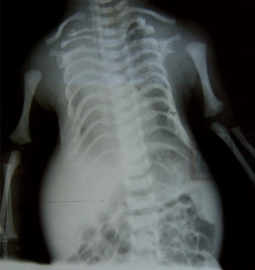 Рентгенограмма грудной клетки