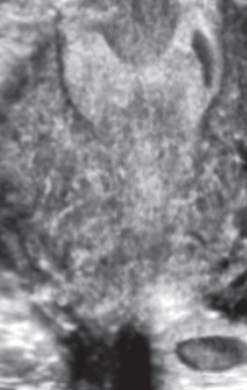 Эхограмма - полость и шейка матки (фронтальный срез)