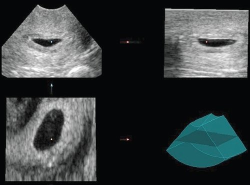 Эхограмма - мультипланарная реконструкция шейки матки