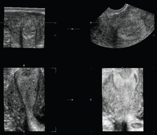 Эхограмма - мультипланарная и поверхностная реконструкция полости и шейки матки