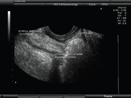 Эхограмма - ректоцеле