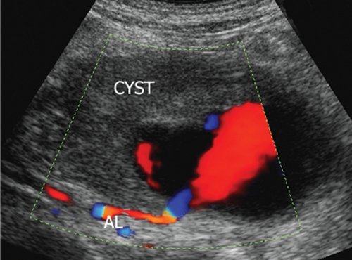 Эхограмма ложной аневризмы селезеночной артерии (режим ЦДК): AL - селезеночная артерия, CYST - постнекротическая киста