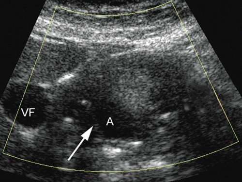 УЗ картина полости аневризмы через 3 суток после эндоваскулярного вмешательства - полость аневризмы (А) в режиме ЦДК не окрашивается, в ней определяются линейные гиперэхогенные структуры, контуры кисты нечеткие, ровные (VF - желчный пузырь)