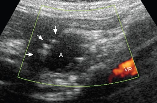 УЗ картина полости аневризмы через 45 суток после эндоваскулярного вмешательства - полость аневризмы (А) в режиме энергетического допплера не окрашивается, по внутреннему латеральному контуру полости определяются округлые гиперэхогенные структуры (указаны стрелками), контуры кисты четкие, ровные (продольное сканирование, VP - воротная вена)