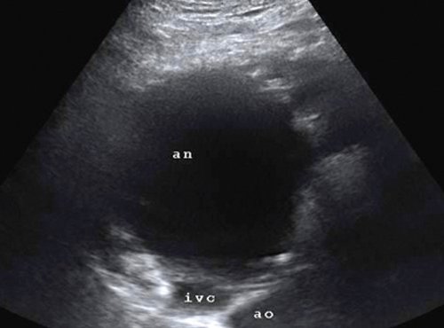 Эхограмма ложной аневризмы в проекции головки поджелудочной железы: an - аневризма, ivc - нижняя полая вена, ao - аорта