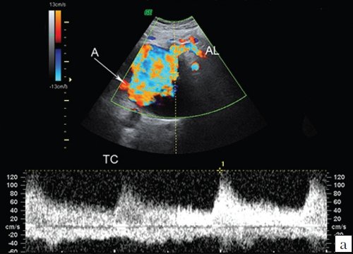 Эхограмма полости ложной аневризмы (режим ЦДК с регистрацией спектра допплеровских частот): А - ложная аневризма, TC - чревный ствол, AL - селезеночная артерия