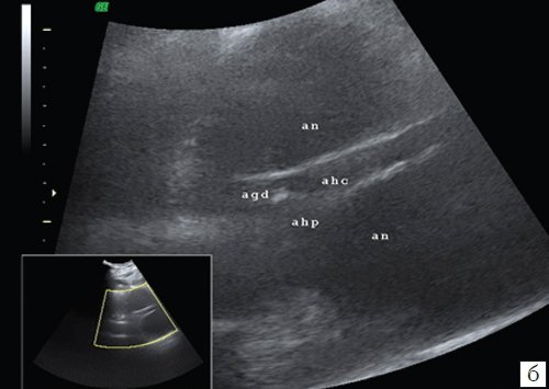 Эхограмма общей печеночной артерии и ее ветвей, распластанной на аневризме: an - аневризма, ahc - общая печеночная артерия, agd - желудочно-двенадцатиперстная артерия, ahp - собственная печеночная артерия