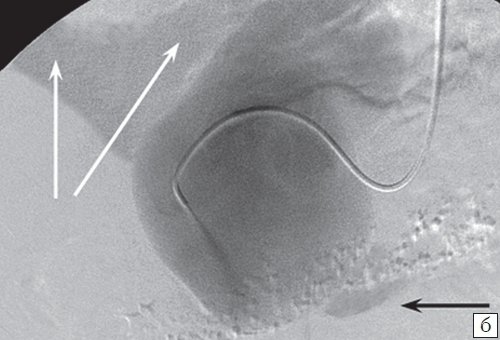 Ангиография после катетеризации аневризмы желудочнодвенадцатиперстной артерии - при введении контрастного вещества контрастируются: верхняя брыжеечная вена (отмечена черной стрелкой) и ветви воротной вены (отмечены белыми стрелками)