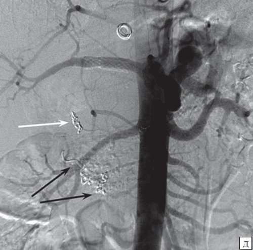 Ангиография брюшного отдела аорты - полость аневризмы не контрастируется, общая и собственная печеночные артерии проходимы, визуализируются эмболизационные спирали в желудочно-двенадцатиперстной артерии и в ветвях поджелудочно-двенадцатиперстной артерии