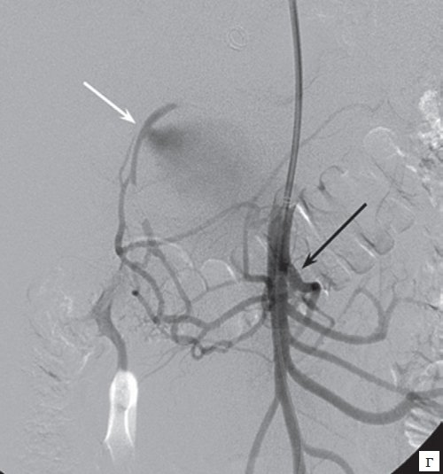 Верхняя мезентерикография - визуализируются множественные коллатерали между бассейнами желудочно-двенадцатиперстной и поджелудочно-двенадцатиперстной артерий со сбросом контрастного вещества в полость аневризмы