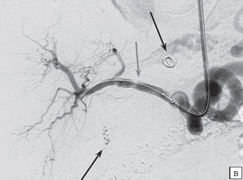 Целиакография после имплантации в общую и собственную печеночные артерии стент-графтов - визуализируются спирали в дистальной части желудочно-двенадцатиперстной артерии и спираль большего диаметра в полости аневризмы