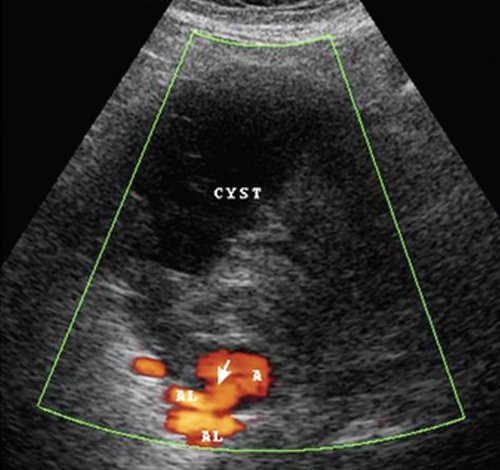 Эхограмма селезеночной артерии, источника аневризмы (режим энергетического допплера): AL - селезеночная артерия, CYST - постнекротическая киста