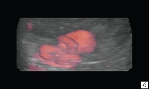 Эхограмма селезеночной артерии, источника аневризмы (режим 3D, ультразвуковая ангиография)