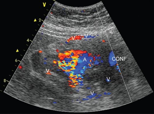 Эхограмма аневризмы желудочно-двенадцатиперстной артерии до оперативного вмешательства (режим ЦДК): A - аневризма, CONF - конфлюенс воротной вены, V - венозные коллатерали