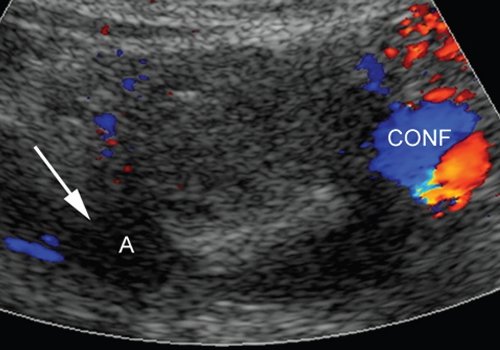 УЗ картина полости аневризмы непосредственно после эндоваскулярного вмешательства - полость аневризмы (А) в режиме ЦДК не окрашивается (CONF - конфлюенс воротной вены)