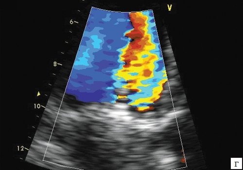 ЭхоКГ изображение дискового протеза в митральной позиции с цветным картированием транспротезного потока