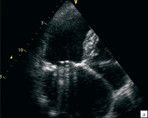ЭхоКГ изображение двустворчатого протеза в митральной позиции из апикального доступа