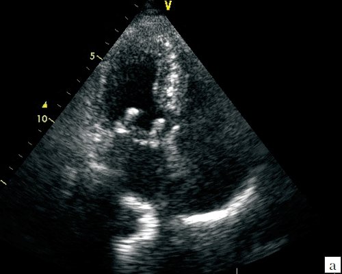 ЭхоКГ изображение биологического протеза (Sorin Perikarbon) в митральной позиции из апикального доступа