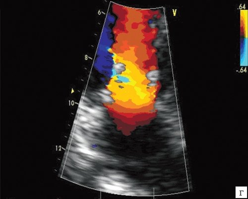 ЭхоКГ изображение биологического протеза (Sorin Perikarbon) в митральной позиции с цветным картированием транспротезного потока
