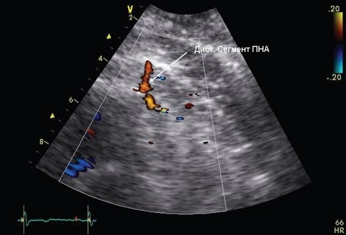 Эхограмма дистального сегмента передней нисходящей коронарной артерии