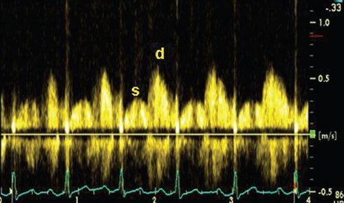 Допплеровский спектр коронарного потока (s - поток в период систолы, d - поток в период диастолы)