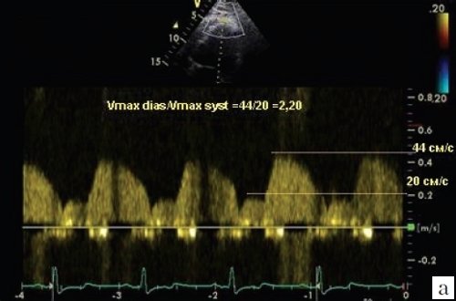 Допплеровский спектр потока в дистальном сегменте ПНА у больного с АГ с концентрической гипертрофией левого желудочка и ангиографически не измененной ПНА