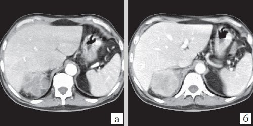 КТ почки (а - артериальная фаза, б - паренхиматозная фаза контрастирования) - почечно-клеточная карцинома (10)