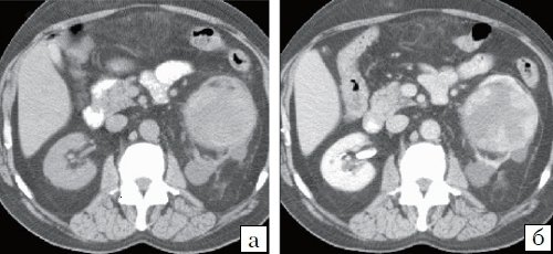 КТ почки (а - до контрастирования, б - после контрастирования) - почечно-клеточная карцинома (3)