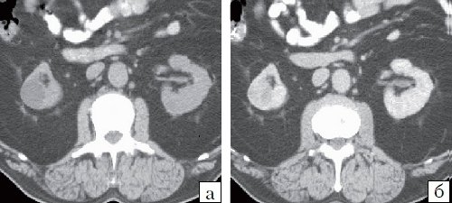 КТ почки (а - до контрастирования, б - после контрастирования) - почечно-клеточная карцинома (4)