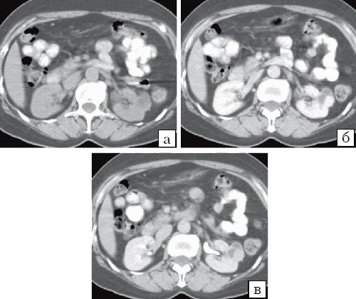 КТ почки (a - до контрастирования, б - паренхиматозная фаза; в - артериальная фаза контрастирования) - почечно-клеточный кистозный рак (5)