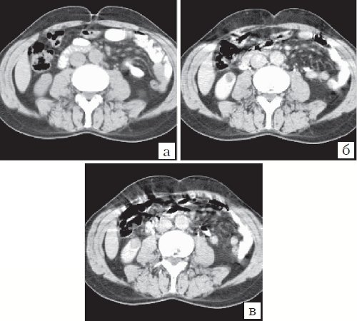 КТ почки (а - до контрастирования, б и в - после контрастирования) - кистозный почечно-клеточный рак (6)