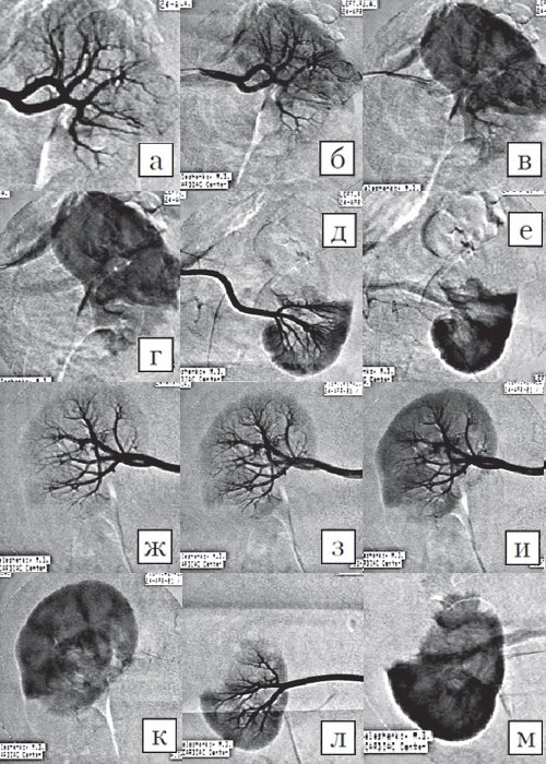 КТ - аортография, селективная артериография ветвей аорты и кавография, злокачественные объемные образования обеих почек