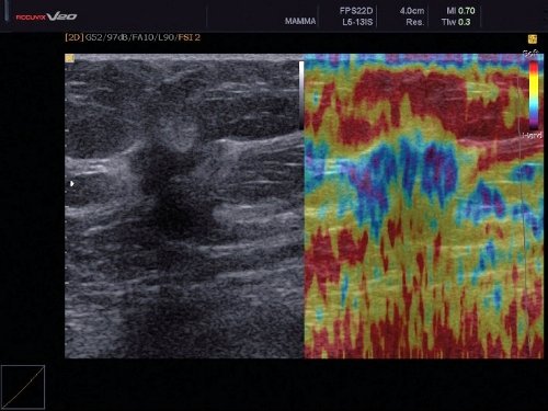 BI-RADS V: ЭластоСкан выявил высокую плотность опухоли, отображенную синим и фиолетовым цветом