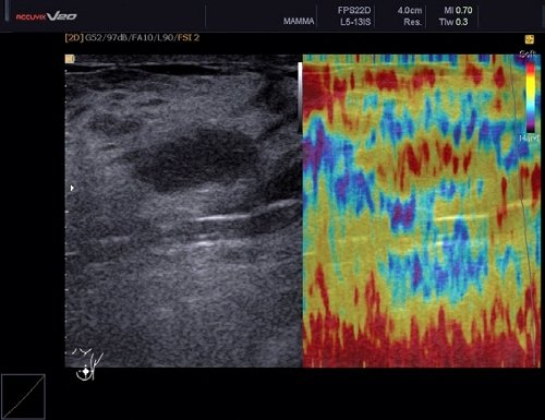 BI-RADS II: ЭластоСкан отобразил образование желтым и красным цветом, а окружающую фиброзно-железистую ткань синим