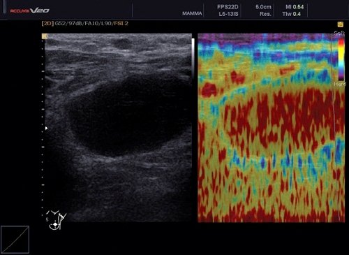 Эхография показала отсутствие образования в молочной железе. ЭластоСкан™ продемонстрировал, что узел эластичный (красный и желтый цвет)