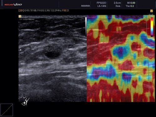 BI-RADS II: ЭластоСкан показал, что образование плотное (синий и фиолетовый цвет)