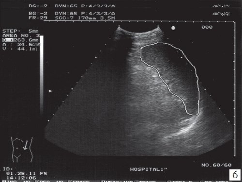 Эхограмма селезенки (площадь не увеличена)