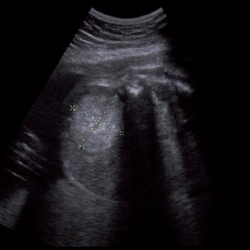 Эхограмма - нейробластома правого надпочечника плода, беременность 31 нед 4 дня 