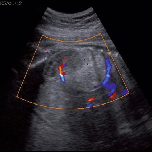 Эхограмма - кровоток в нейробластоме плода (режим ЦДК), отчетливо виден питающий сосуд, огибающий образование по его периферии, к нижнему полюсу образования прилежит интактная почка плода