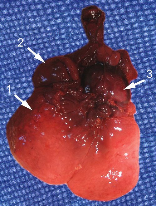 Органокомплекс, вид спереди: 1 - печень, 2 - опухоль с правым надпочечником, 3 - сердце