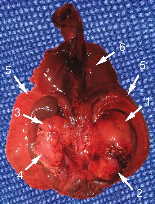 Органокомплекс, вид сзади: 1 - опухоль с правым надпочечником, 2 - правая почка, 3 - левый надпочечник, 4 - левая почка, 5 - печень, 6 - метастазы в легкие