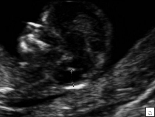 Эхограмма - аномалия Денди-Уокера: киста в области большой цистерны, сливающаяся с IV желудочком; визуализируется сосудистое сплетение IV желудочка на границе слияния