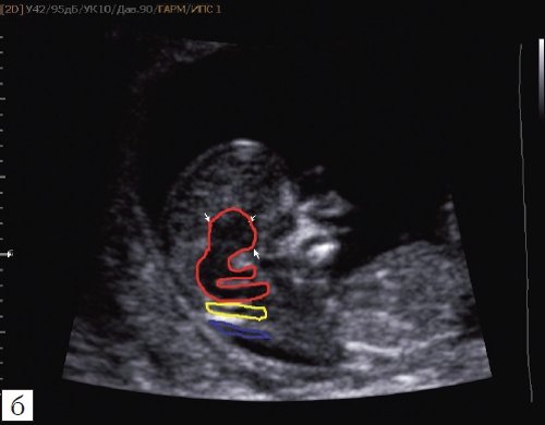 Ультразвуковая анатомия структур головного мозга плода: красный цвет - диэнцефалон (таламус), со стволом мозга (верхняя ножка) и IV желудочком (нижняя ножка); желтый цвет - большая цистерна головного мозга; синий цвет - воротниковое пространство